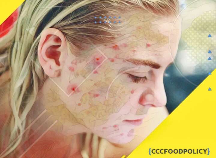 tipuri de acnee
